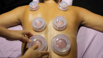 Cupping Treatment Image