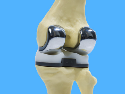 Knee Replacement image